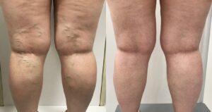 Varicose Veins – Various Causes, Remedies, and Treatments