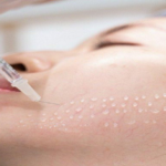 Mesotherapy in Dubai : Unlock Radiant Skin Through Revolutionary