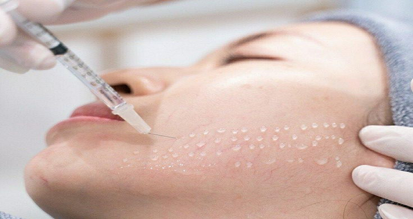 Mesotherapy in Dubai : Unlock Radiant Skin Through Revolutionary